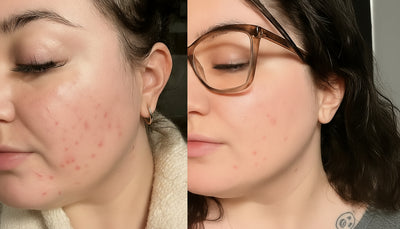 NuDerma Clinical Facial Wand – Wrinkle Reduction & Skin Tightening