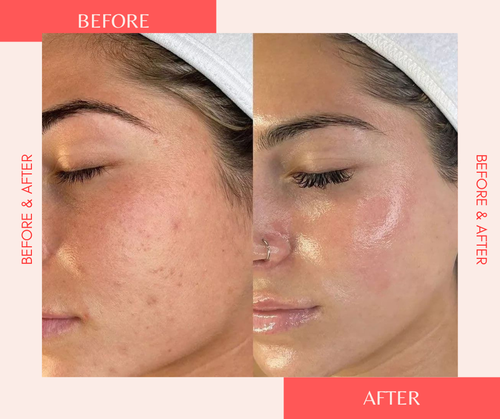 Wireless LED Light Therapy Face Mask