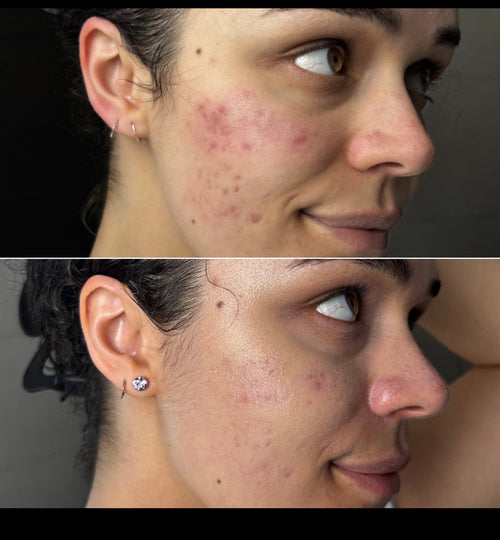 Wireless LED Light Therapy Face Mask